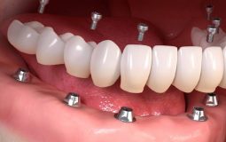 Trồng răng Implant cả hàm - Khôi phục hàm răng hoàn hảo